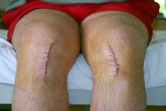 Knee Incisions