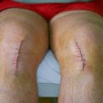 Minimally invasive knee replacement
