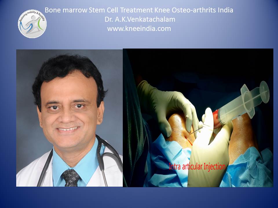 stem cell treatment for knee